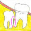 Vertical impacted wisdom tooth disimpaction treatment