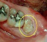 Wisdom teeth disimpaction procedure overview at Denticare India