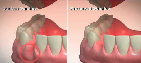 Surgical tooth extraction and socket preservation procedure at DentiCare India