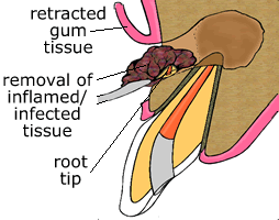 Step 2 animation showing cyst enucleation and root canal treatment
