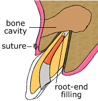 Step 3 animation showing retrograde filling during apicoectomy surgery