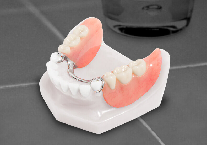 Cast Partial Dentures Denticare Cast partial dentures procedure and metal framework at DentiCare India
