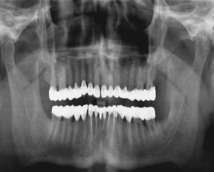 After full mouth rehabilitation treatment successful smile makeover