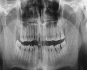 Before full mouth rehabilitation treatment smile transformation