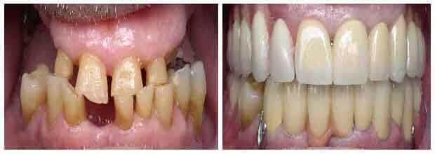 Full mouth rehabilitation procedure at DentiCare India