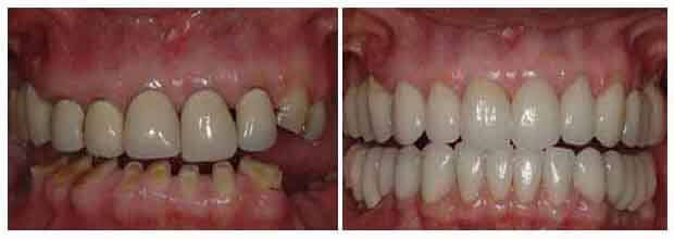 Patient undergoing full mouth rehabilitation treatment