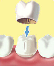 Dental Crown Procedure - Denticare