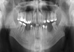 Crowns and Bridges Before Treatment - Denticare