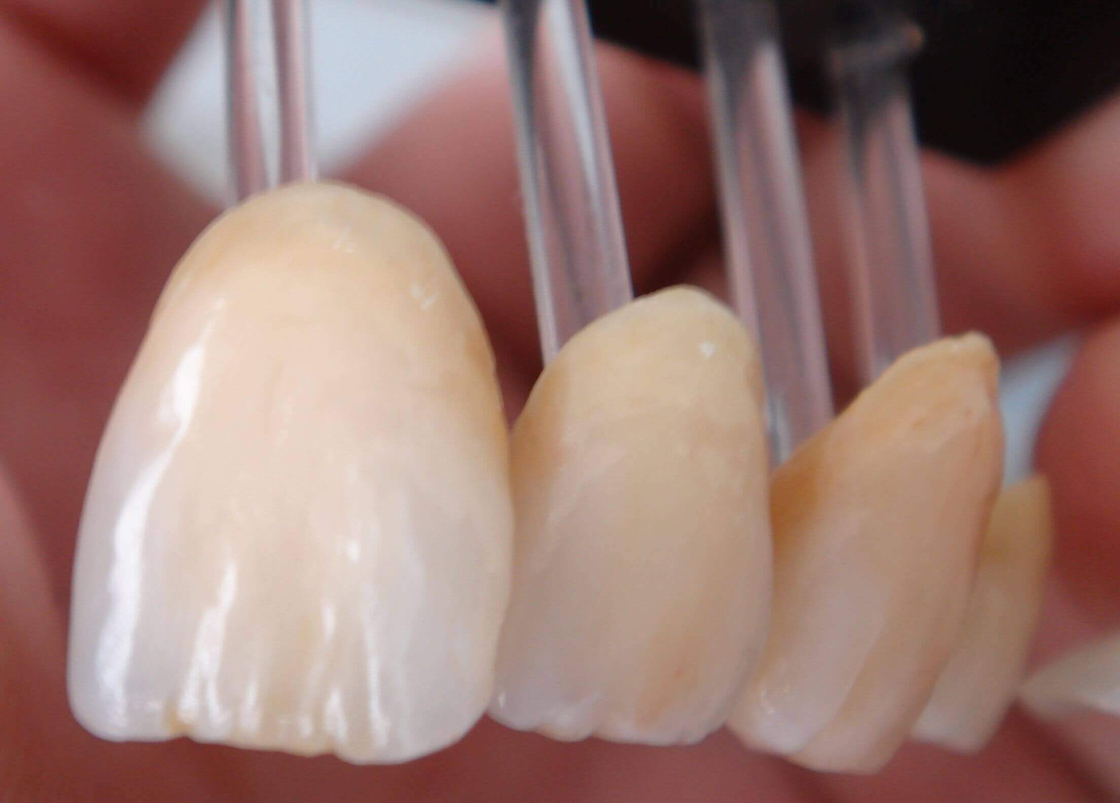 Emax Crowns - Denticare