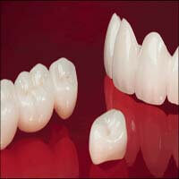Lava Crowns - Denticare