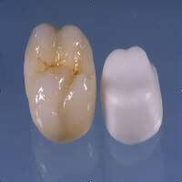 Procera Dental Crowns - Denticare