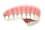Completed single tooth dental implant result view
