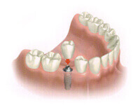 Single tooth dental implant procedure step 1 illustration