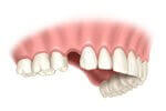 Single tooth dental implant placement procedure step 2