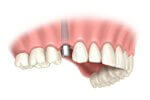 Single tooth dental implant abutment placement step 3