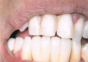 Post-treatment view for successful 2 implant bridge