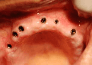 Hybrid denture option 1 for multiple missing teeth