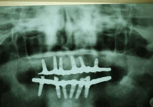 Hybrid denture option 2 for teeth replacement