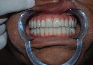 Hybrid denture option 3 for full arch restoration