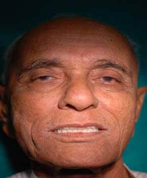 Happy patient smiling after hybrid denture implant procedure