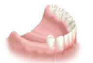 Patient consultation for multiple teeth implants treatment
