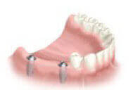 Step-by-step process of multiple teeth dental implants