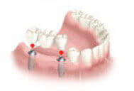 Advanced technology used for multiple teeth implants