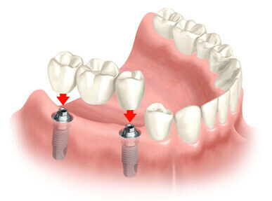 Overview of multiple teeth implants procedure at DentiCare India
