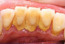 Teeth condition before dental scaling treatment