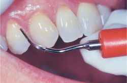 Ultrasonic teeth scaling treatment at Denticare India clinic