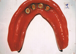 Lower Denture with Socket Attachments - Denticare