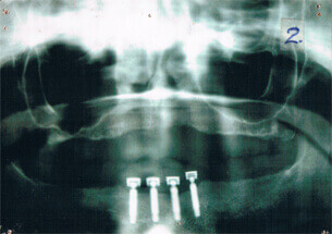 Radiograph of Dental Implants - Denticare