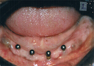 Implant with Ball Attachments - Denticare