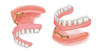 Close-up view of implant supported retrievable dentures