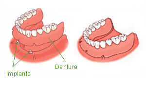 Implant supported retrievable dentures procedure illustration