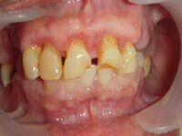 After drug-induced abscess flap surgery recovery at DentiCare India