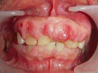Before drug-induced abscess flap surgery treatment at DentiCare India