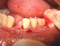 Infection removal during flap surgery procedure at DentiCare India