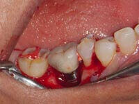 After peri-implantitis flap surgery treatment results at DentiCare India