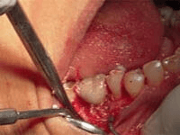 Before peri-implantitis flap surgery treatment at DentiCare India