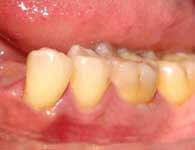 Post-flap surgery recovery and results at DentiCare India