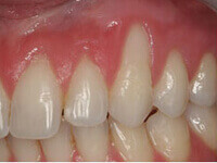 Advanced root coverage surgery techniques by DentiCare India specialists