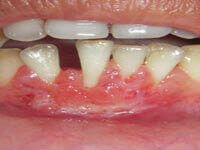 Free gingival graft after successful recovery and gum tissue healing