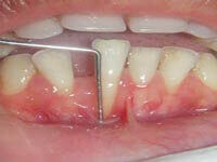 Free gingival graft before treatment showing gum recession