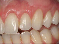 Patient undergoing root coverage surgery at DentiCare India