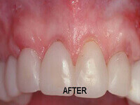 After root coverage surgery results showing restored gum line at DentiCare India