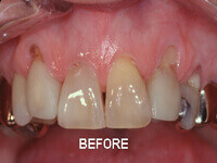 Before root coverage surgery showing gum recession at DentiCare India