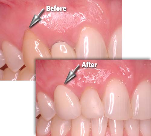 Root coverage surgery procedure overview at DentiCare India