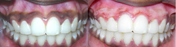 Gum depigmentation treatment procedure at Denticare India