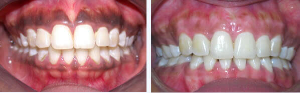 Patient undergoing gum depigmentation therapy